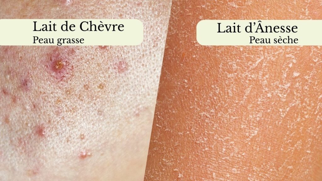Photo montrant de pres un exemple de peau grasse et un exemple de peua seche avec la correspondence de savon au lait de chevre ou lait d'anesse adapte au type de peau.